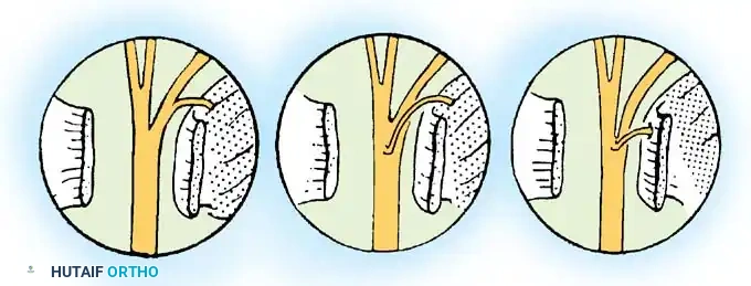 Carpal Tunnel Syndrome: A Comprehensive Operative Guide for Advanced Orthopaedic Surgeons