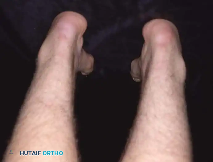 Idiopathic Pes Cavus