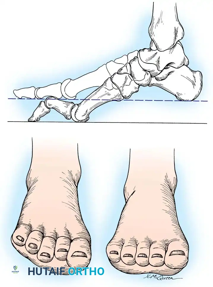 Plantar Flexed First Ray in CMT
