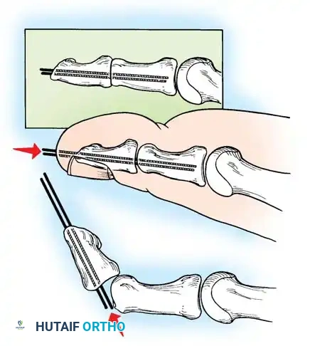 Hutaifortho's Orthopaedic Diagram