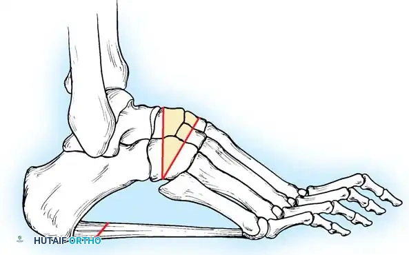 Surgical Osteotomy Planning