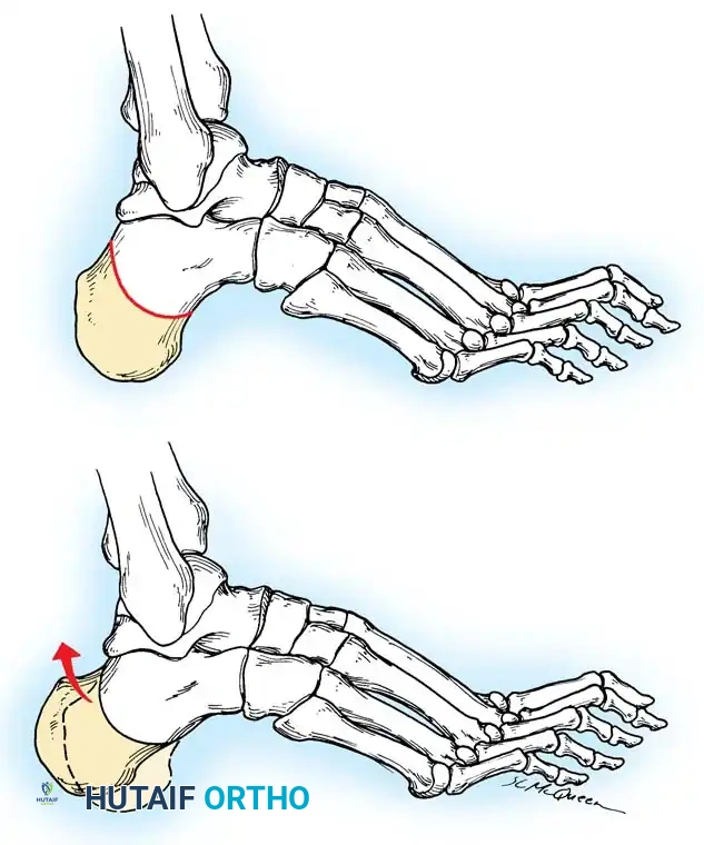 Tendon Transfer Biomechanics