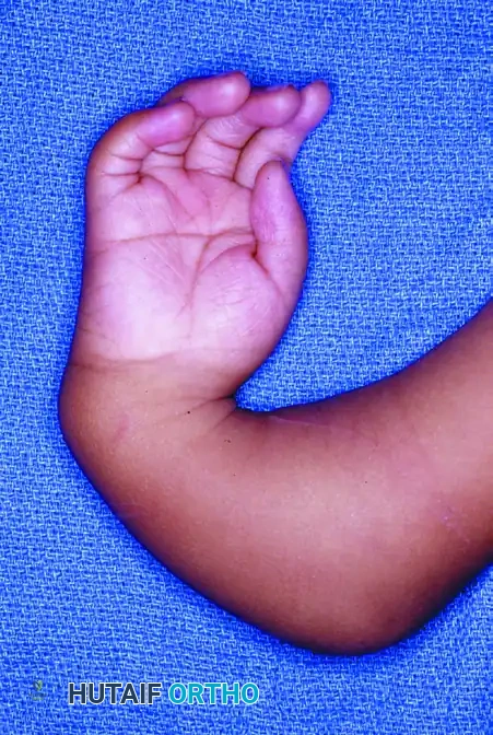 Centralization of the Hand: Transverse Ulnar Incision Technique