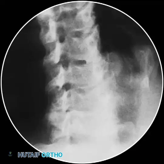 CERVICAL DISC DISEASE Surgical Diagram