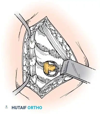 الدليل الشامل لمرض الانزلاق الغضروفي العنقي: الأعراض والعلاج