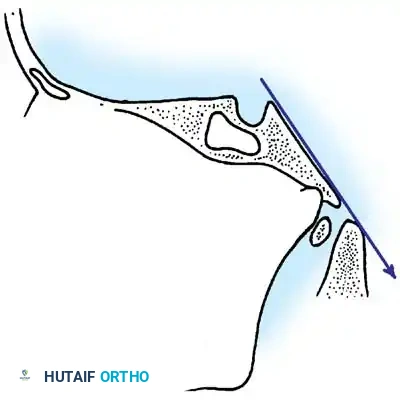 Sella tubercle