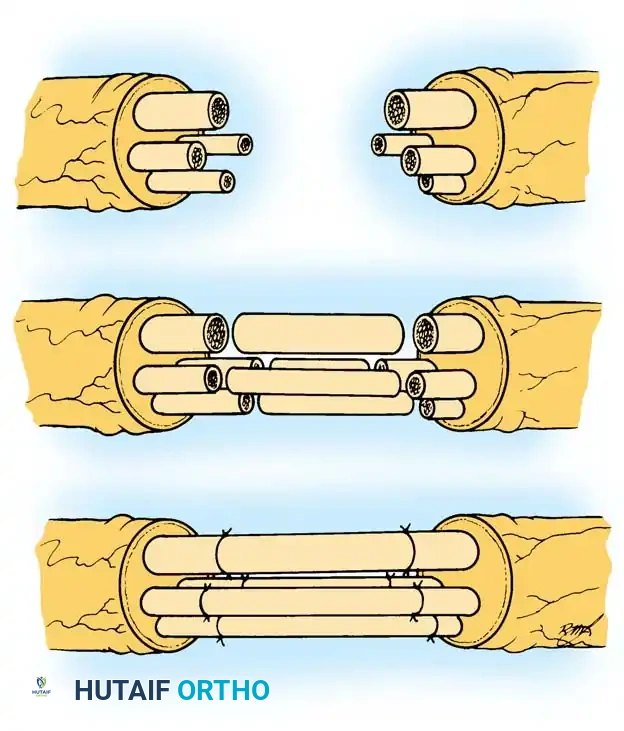 Spinal Accessory Nerve Injury & Repair: Surgical Guide