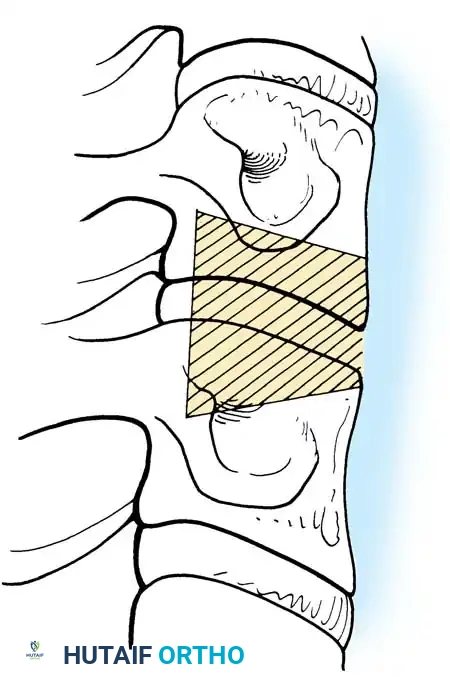 تشكيل الطعم العظمي ليناسب الانحناء الطبيعي للرقبة