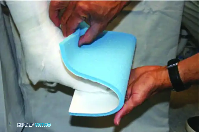 CHARCOT ARTHROPATHY Surgical Diagram