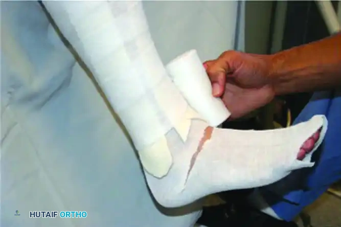 CHARCOT ARTHROPATHY Surgical Diagram