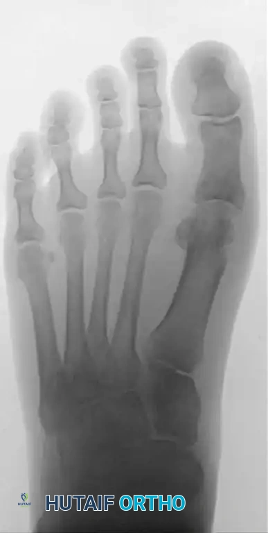 1 year post-op X-ray E