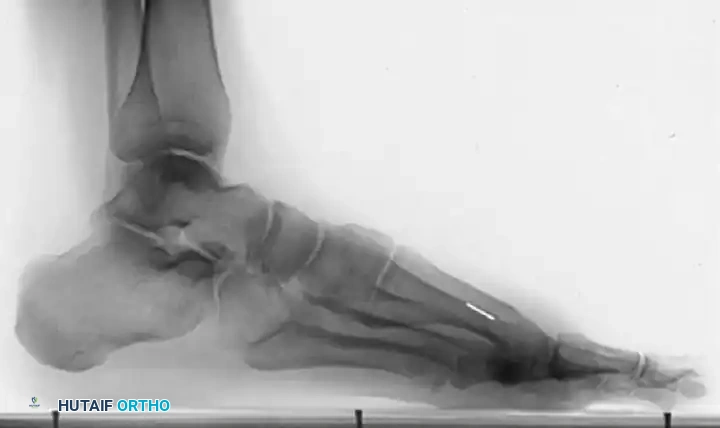 1 year post-op X-ray D