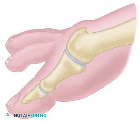 Pfeffer line of resection