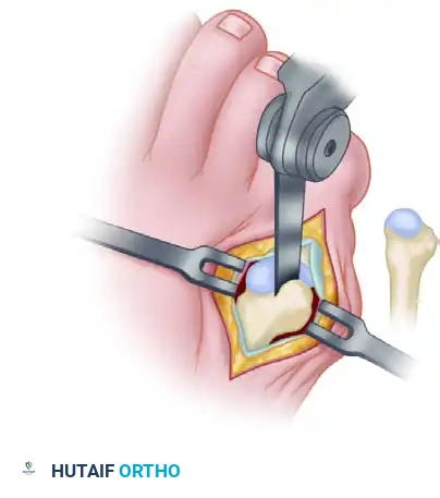CHEVRON OSTEOTOMY OF THE FIFTH METATARSAL FOR BUNIONETTE DEFORMITY Surgical Diagram