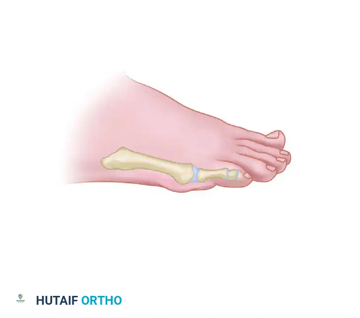 CHEVRON OSTEOTOMY OF THE FIFTH METATARSAL FOR BUNIONETTE DEFORMITY Surgical Diagram