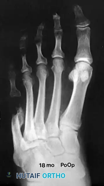CHEVRON OSTEOTOMY OF THE FIFTH METATARSAL FOR BUNIONETTE DEFORMITY Surgical Diagram