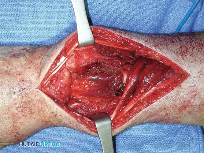 CHONDROBLASTOMA Surgical Diagram
