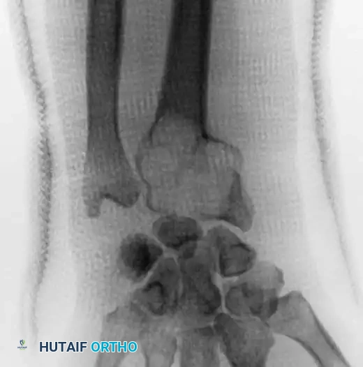 CHONDROBLASTOMA Surgical Diagram