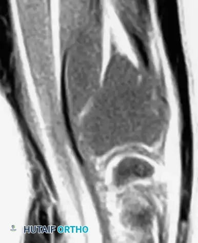 CHONDROBLASTOMA Surgical Diagram