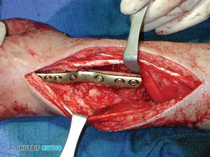 CHONDROBLASTOMA Surgical Diagram