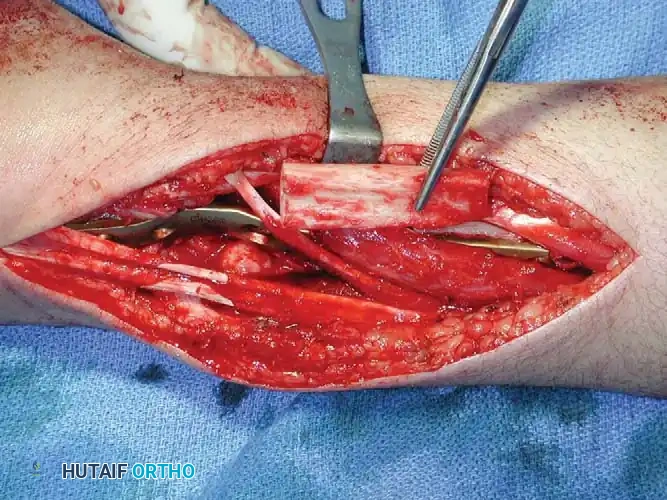CHONDROBLASTOMA Surgical Diagram