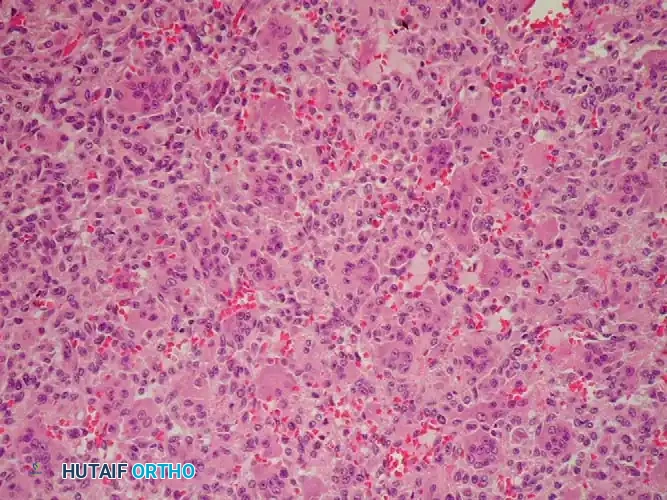 CHONDROBLASTOMA Surgical Diagram