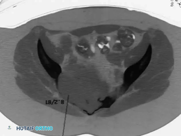 CHONDROBLASTOMA Surgical Diagram