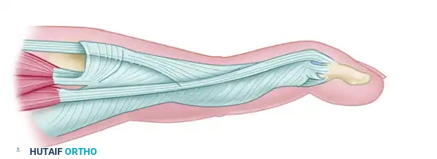CHRONIC MALLET FINGER (SECONDARY REPAIR) Surgical Diagram