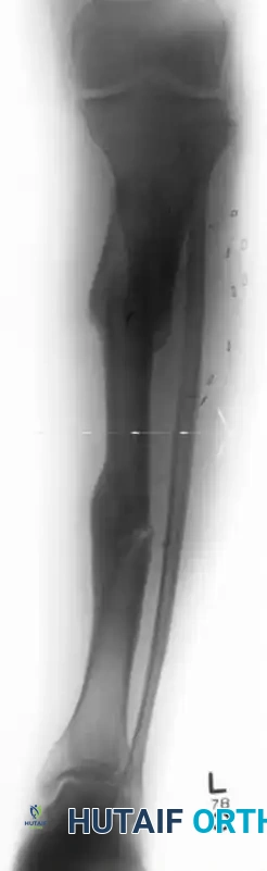 Clamshell Osteotomy for Complex Diaphyseal Malunions: A Comprehensive Surgical Guide