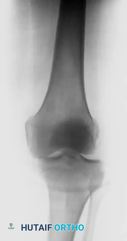 Comprehensive Management of Knee Dislocations: Classification, Evaluation, and Surgical Reconstruction