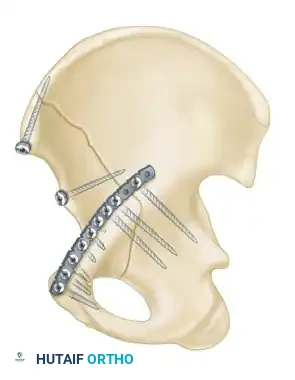CLASSIFICATION Surgical Diagram