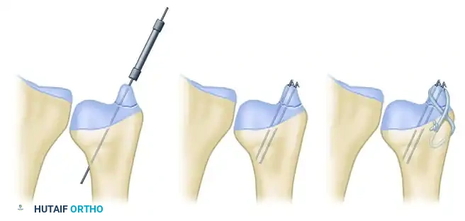 CLASSIFICATION Surgical Diagram