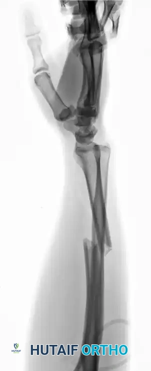 Distal Radius Fractures: Comprehensive Classification, Stability Assessment, and Operative Management