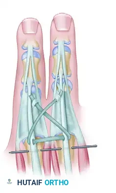 CLEFT CLOSURE AND RELEASE OF THUMB ADDUCTION CONTRACTURE Surgical Diagram