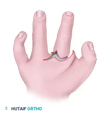 CLEFT CLOSURE AND RELEASE OF THUMB ADDUCTION CONTRACTURE Surgical Diagram