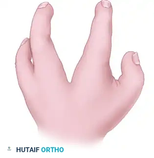 CLEFT CLOSURE AND RELEASE OF THUMB ADDUCTION CONTRACTURE Surgical Diagram