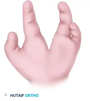 CLEFT CLOSURE AND RELEASE OF THUMB ADDUCTION CONTRACTURE Surgical Diagram