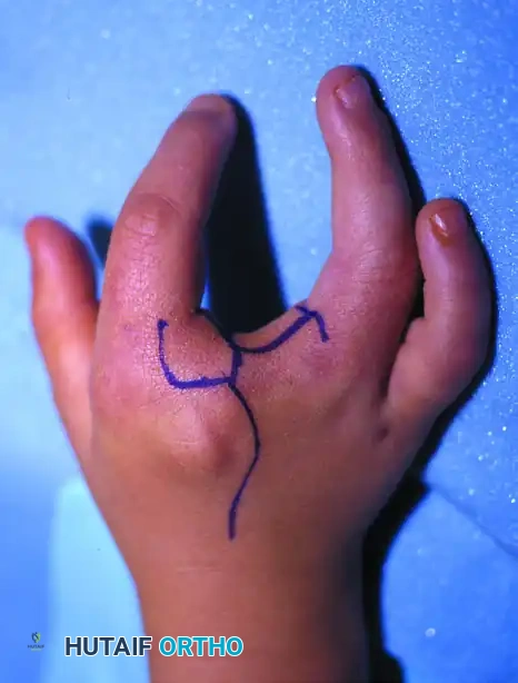 CLEFT CLOSURE Surgical Diagram