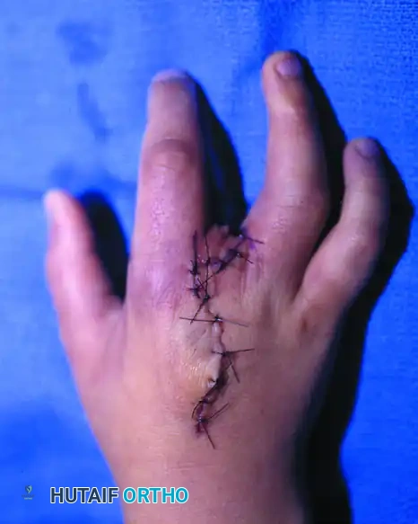CLEFT CLOSURE Surgical Diagram