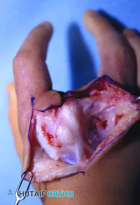 CLEFT CLOSURE Surgical Diagram