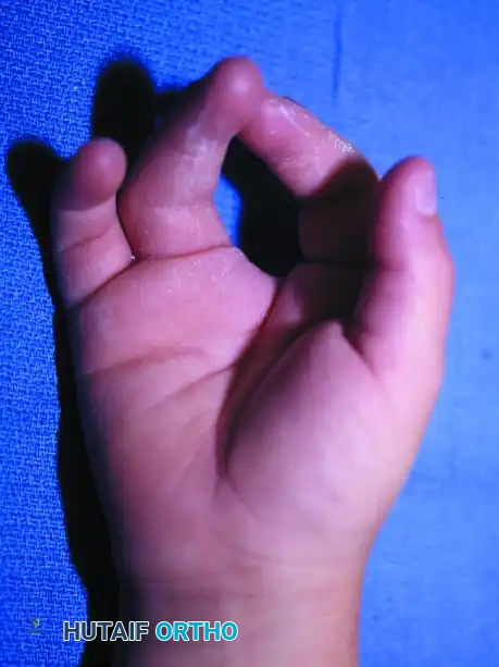 Barsky Technique for Cleft Hand Closure: A Comprehensive Surgical Guide