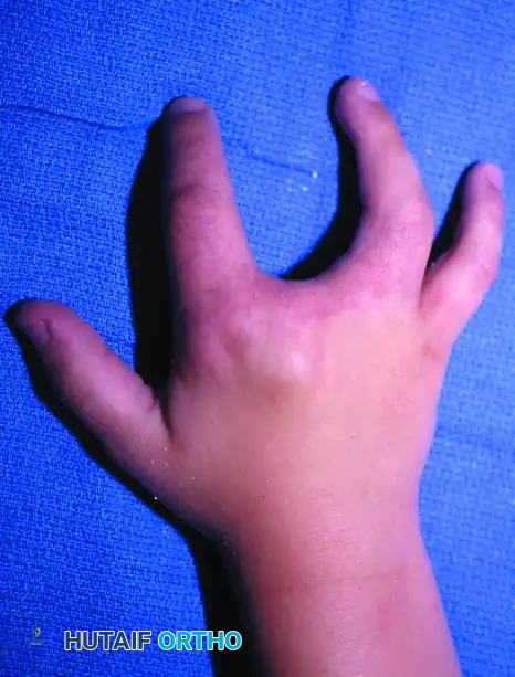 CLEFT CLOSURE Surgical Diagram
