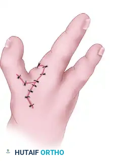 CLEFT CLOSURE Surgical Diagram