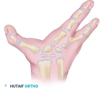 CLEFT CLOSURE Surgical Diagram