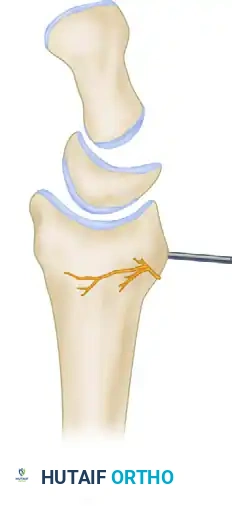 Normal Radiocarpal Alignment