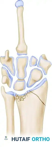 Die-Punch Fracture Volar Tilt