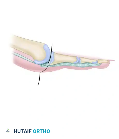 CLINICAL FINDINGS Surgical Diagram