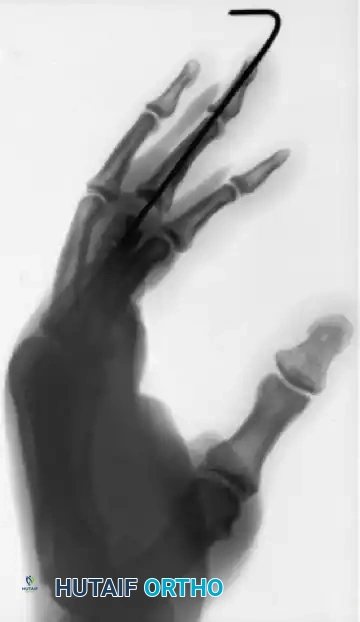 CLOSED PINNING Surgical Diagram