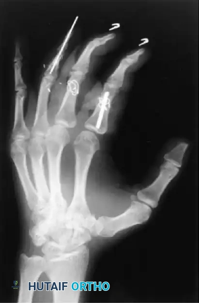 FIGURE 67-7 A and B, Oblique ring finger metacarpal shaft fracture with shortening and malrotation in young woman treated with lag screw technique.