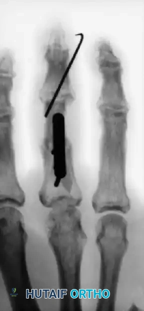 CLOSED PINNING Surgical Diagram